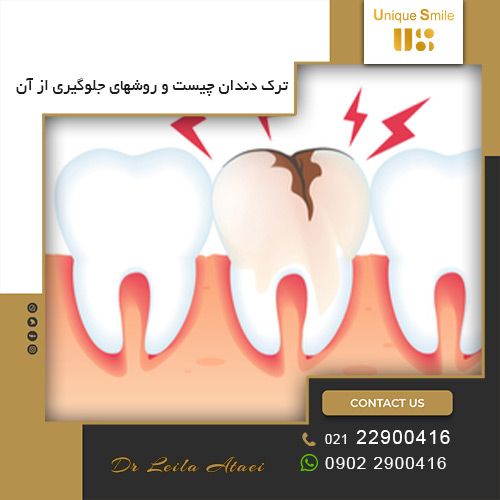 جلوگیری از ترک دندان